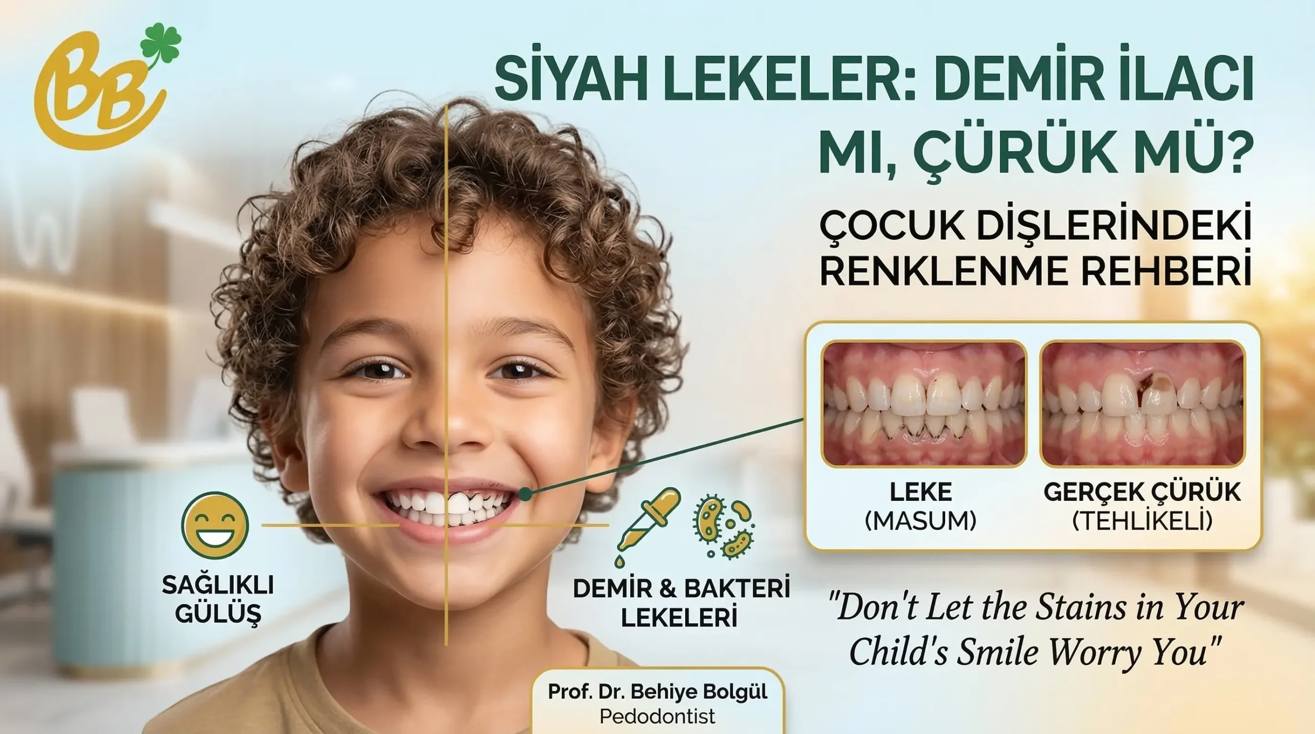 Çocuklarda siyah diş lekeleri, çoğunlukla profesyonel temizlikle giderilebilen masum sebeplerden kaynaklanır. - Black stains on children's teeth are often caused by harmless factors that can be removed with professional cleaning. - Черные пятна на зубах у детей часто вызваны безвредными факторами, которые можно удалить с помощью профессиональной чистки.